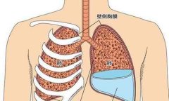 左侧中量胸腔积液严重吗