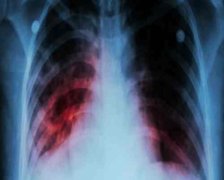 正常人有胸腔积液吗 正常胸腔积液是